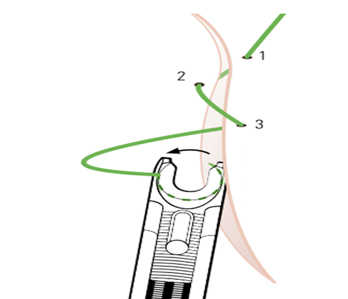鏡下縫合-腔內(nèi)縫合器縫合要領(lǐng)